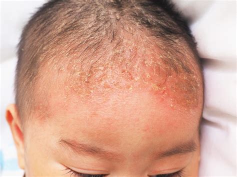 seborrheic dermatitis symptoms treatments