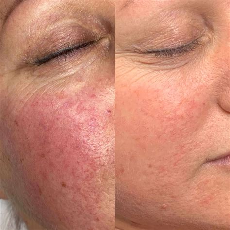 Harmony XL PRO | Clinique de Soins Esthétiques | À ton charme