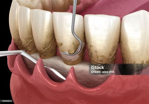 Como É O Procedimento De Curetagem - Foto de Curetagem Aberta Dimensionamento E Planejamento Radicular ...