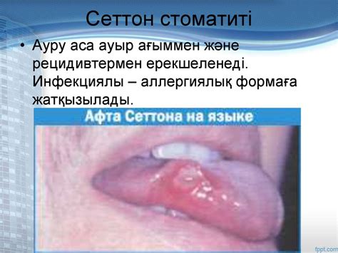 Балалардағы ауыз қуысы шырышты қабатының аллергиялық аурулары ...