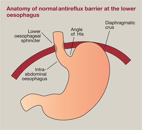 Gastro-oesophageal reflux in children: surgical management - Surgery ...