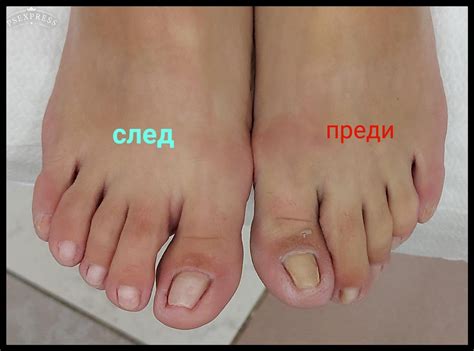 Красиви нокти: Медицински педикюр с лак, гел лак или избелваща ...