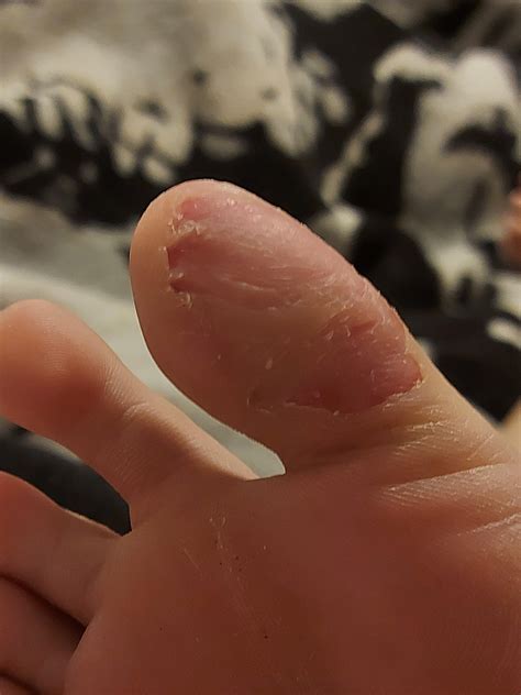 What started off as removing callous is now my coping mechanism when