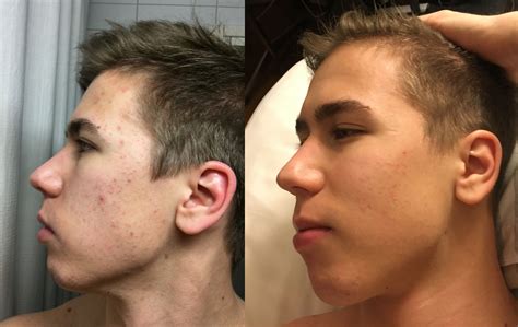 Mild Acne Vulgaris