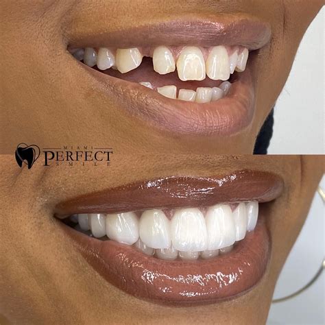 Porcelain veneers before and after by Dr. Helen Carmenate in Miami ...