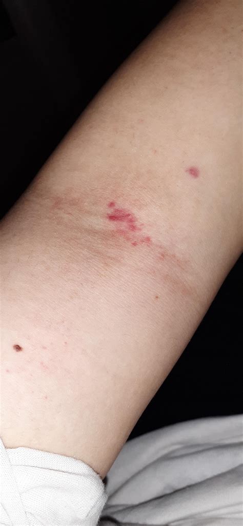 I got this right after waxing. It doesn't hurt or itch. Should I be