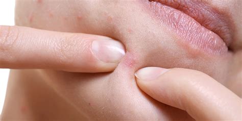 acne redness treatments  prevention tips
