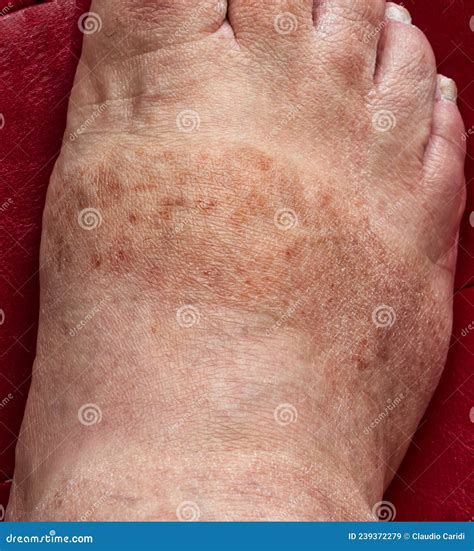 Dark Spots and Dehydrated Skin on Male`s Foot. Dermatological Problems