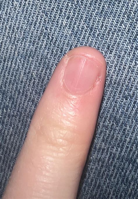 Intense pain : r/Ingrown_Toenails