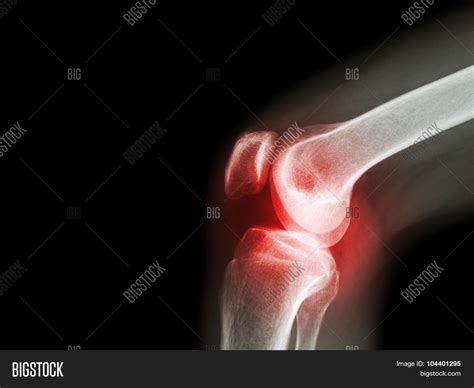 Film X-ray Knee Joint Image & Photo (Free Trial) | Bigstock