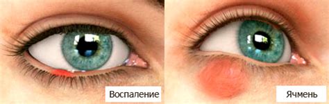 Глазные капли с антибиотиком: применение, список