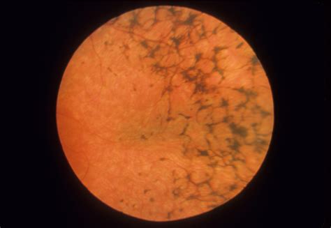 Retinitis Pigmentosa - Home