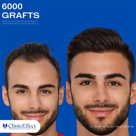 hair transplant turkey hair transplant cost  turkey hair