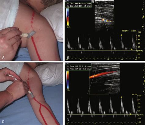 Assessment of Upper Extremity Arterial Disease | Radiology Key