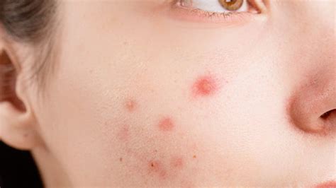 10 Rekomendasi Skincare Paling Ampuh untuk Mengatasi Jerawat Hormonal ...