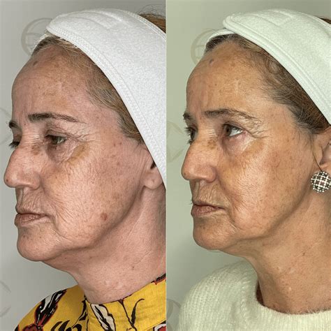 Microagulhamento Antes E Depois Rugas - Tratamento Rugas - Clínica Belmedic - Medicina Estética