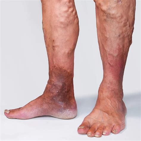 Reticular Veins: Causes, Symptoms & Effective Treatment Options
