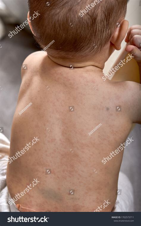 roseola rash viral rash  skin