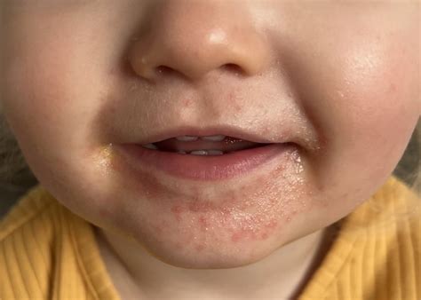 red rash  baby  mouth infoupdateorg