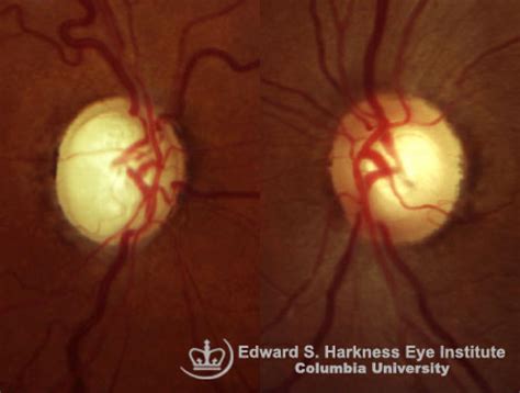 glaucomatous optic nerve vagelos college  physicians  surgeons