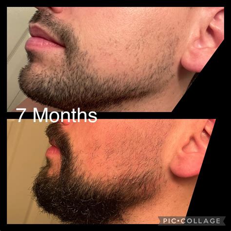 7 months . Getting heart palpitation, thinning head hair. 1-minox/day