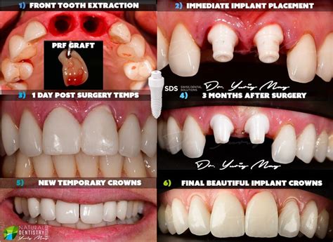 front tooth zirconia implants