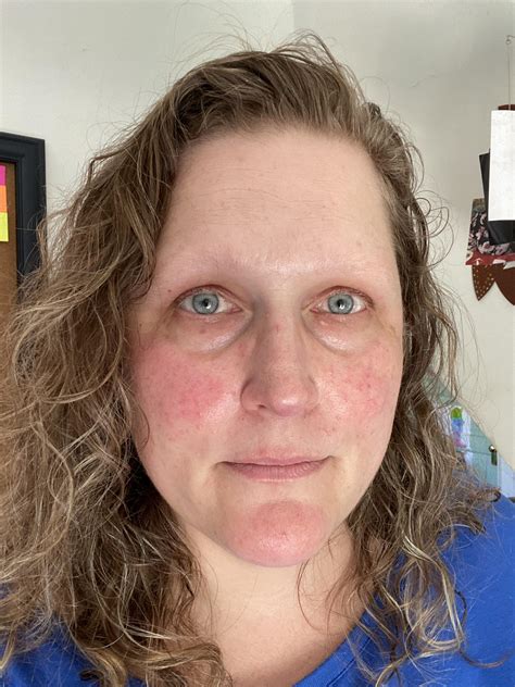 Does diet affect steroid induced rosacea? : Rosacea