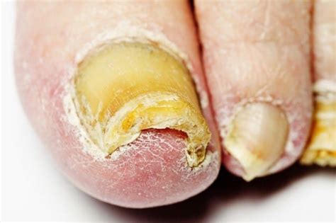 5 Sneaky Solutions For Stunning Toenails