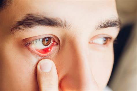 internal stye symptoms  treatment