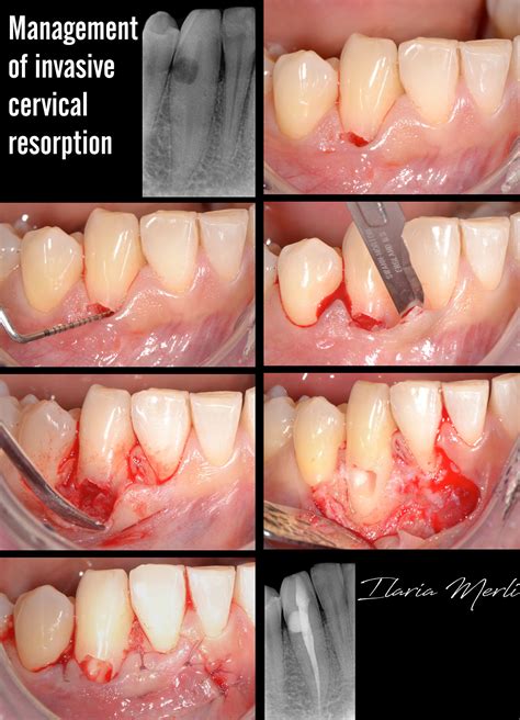 Management of an idiopathic external cervical resorption in the