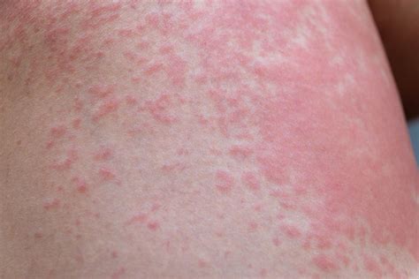 rashes beverly hills treatment  rashes torrance encino ca