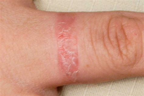 Kontakt Dermatit – TR Uzm. Dr. Emine Gökcan