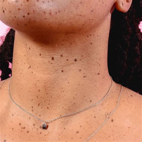 skin tags     remove  popsugar australia