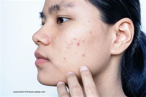 pearls  acne  skin  color