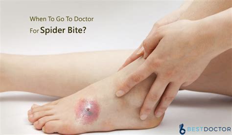 When To Go To Doctor For Spider Bite