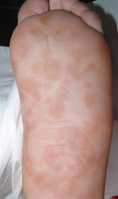 syphilis symptoms syphilis test hcymcb