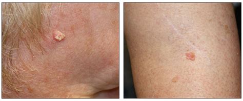 white spot  arm cancer  wm legg blog