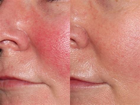 spot check ipl  laser treatment  rosacea