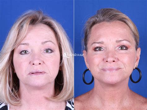 Mini Facelift Photos | Milwaukee | Patient 19998