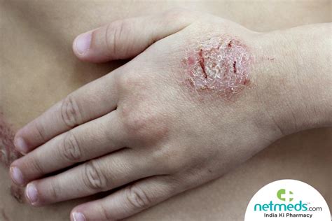 Discoid Eczema: Causes, Symptoms And Treatment, 45% OFF