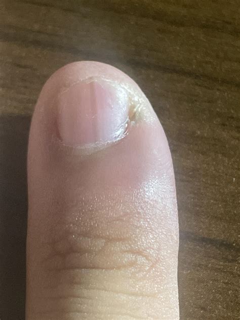 so i have this black line in my fingernail, there is a black dot on the