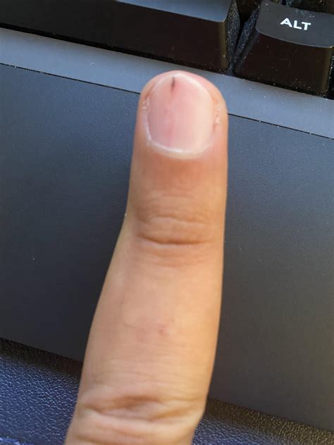 Splinter Hemorrhages Vitamin Deficiency at Evan North blog