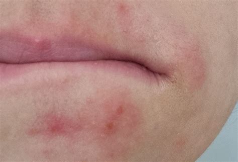 treat perioral dermatits hop cotton