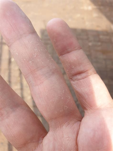 Dry skin 'blisters' : r/DermatologyQuestions