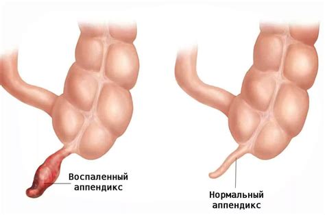 Острый аппендицит: симптомы, диагностика и лечение в Москве — цены и