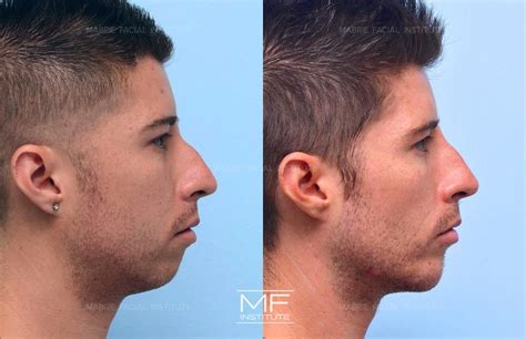 juvederm jowls    dkdermal