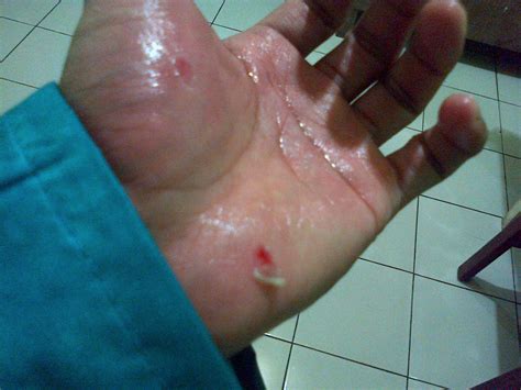 cara menghilangkan bekas luka di lutut 8