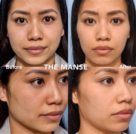 Jawline Slimming - THE MANSE CLINIC