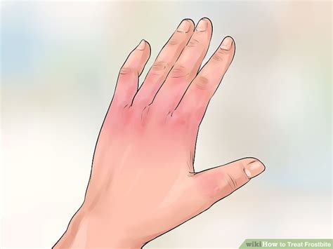 How to Treat Frostbite: 13 Steps (with Pictures) - wikiHow