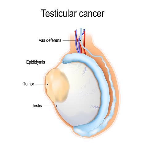 Testicular Cancer Causes | What Are The Risk Factors For Testicular Cancer